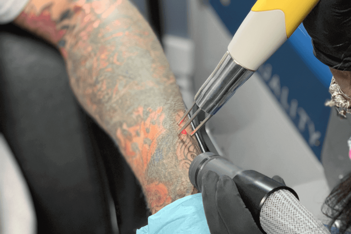 îndepărtați un tatuaj elvețian anti-îmbătrânire